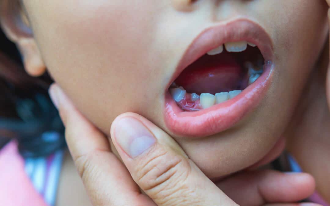 When Do Children Start Losing Baby Teeth?: A Complete Guide for Parents