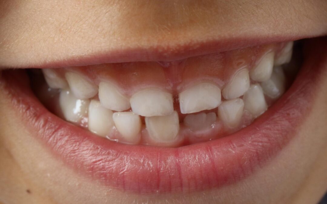 3 Common Myths Parents Believe About Cavities in Milk Teeth